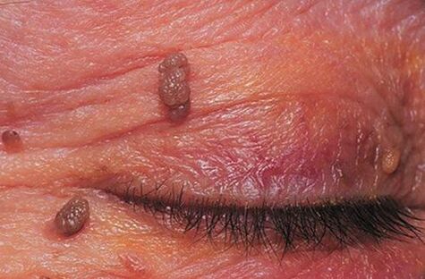 Papillomas on the skin of the eyelids requiring treatment