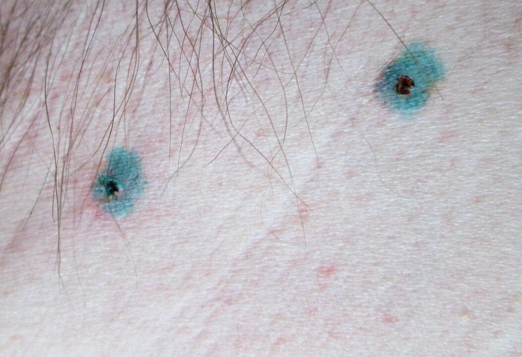 Signs on the skin after laser removal of papillomas